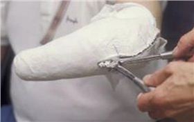 瑞典大學生開發出易于操作的3D打印定制假肢工藝
