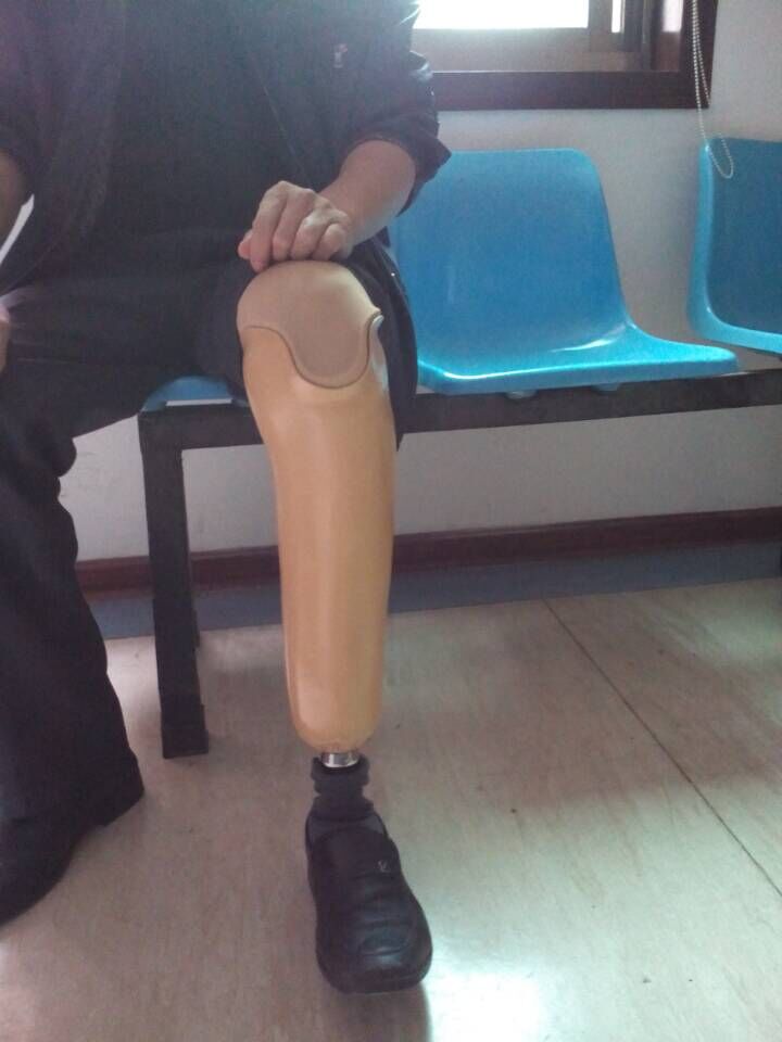 左小腿假肢裝配康復(fù)案例