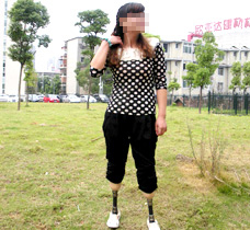 雙小腿假肢裝配