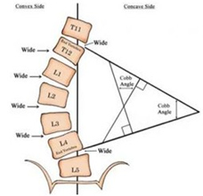 脊柱側(cè)彎角度測(cè)量方式之Cobb角測(cè)量法 | 佳滿假肢