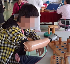 佳滿假肢上肢假肢|肌電手裝配案例