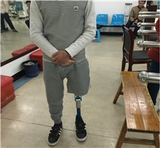 高中生大腿假肢安裝和康復訓練視頻