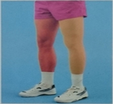 湖南佳滿假肢下肢假肢之大腿假肢安裝案例