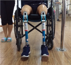 極短殘肢大腿假肢康復訓練
