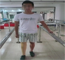 右小腿假肢裝配案例