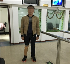 安裝小腿假肢之后竟然變成這樣