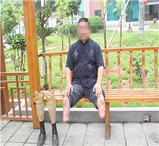 雙小腿假肢安裝