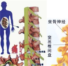 腰椎間盤(pán)突出患者怎樣注意睡姿和適當(dāng)?shù)倪\(yùn)動(dòng)
